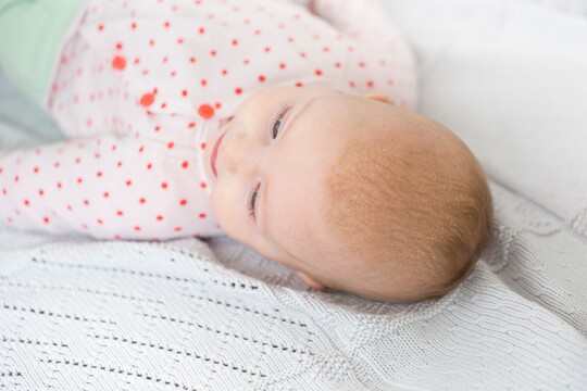 Baby mit Kopfgneis