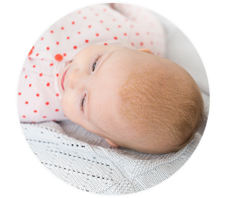 Baby mit Kopfgneis auf der Kopfhaut