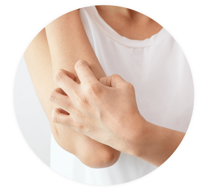 Frau mit Schuppenflechte leidet an Juckreiz. LOYON® kann helfen diesen zu lindern