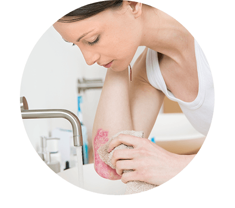 Frau wäscht nach Loyon Behandlung die Hautschuppen ab