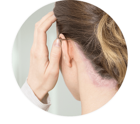 Frau mit Psoriasis am Ohr