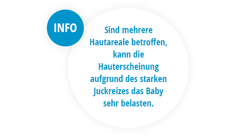 Hinweis zum Juckreiz von Milchschorf bei Babys