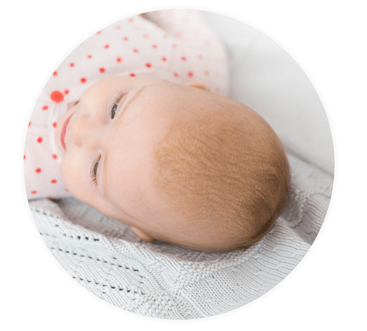 Kopfgneis Bei Babys Symptome Ursachen Loyon
