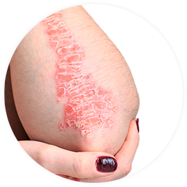 Frau mit der Schuppenflechte Psoriasis vulgaris am Arm