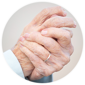 Hände mit Psoriasis-Arthritis, eine Gelenkerkrankung, die bei Schuppenflechte-Betroffenen auftreten kann