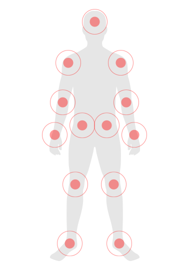 Grafik mit Körperstellen, wo Psoriasis vorkommen kann
